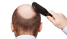 روش‌های درمان ریزش مو از کاشت مو تا دارو‌های مختلف