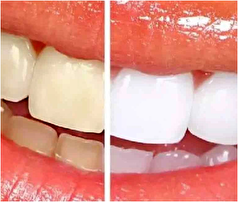 چرا دندان هایمان زرد می‌شوند؟ /چگونه زردی دندان را برطرف کنیم؟