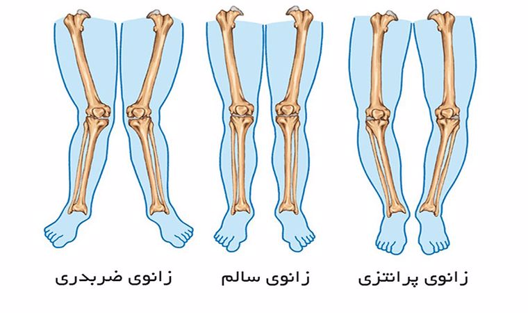 معرفی ناهنجاری پای ضربدری و درمان آن با ۵ حرکت اصلاحی فوق‌العاده