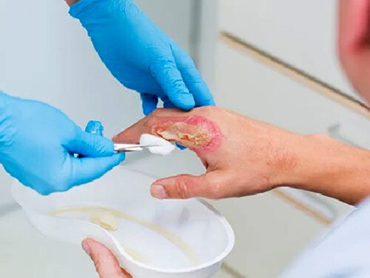 حال فرد دست فروش دچار سوختگی، خوب گزارش شده است