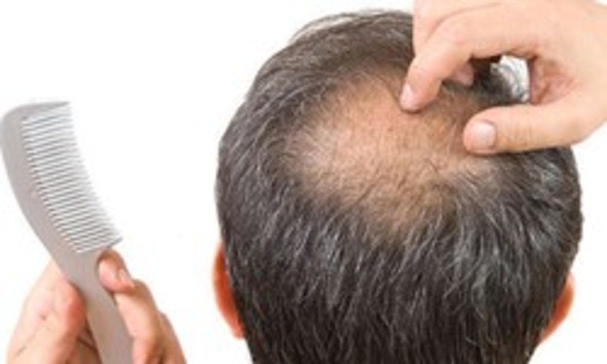 چرا مبتلایان به کرونا دچار ریزش مو می‌شوند؟