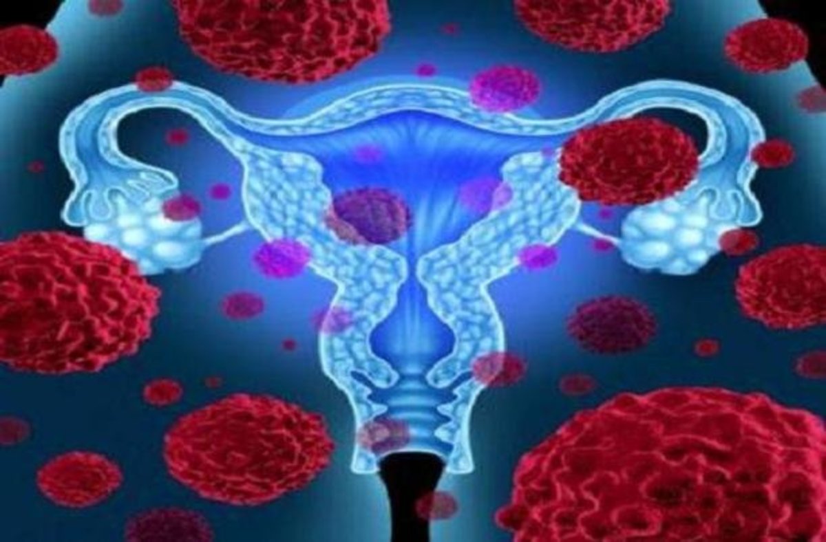 کاهش ۸۷ درصدی ریسک ابتلا به سرطان رحم با واکسن HPV