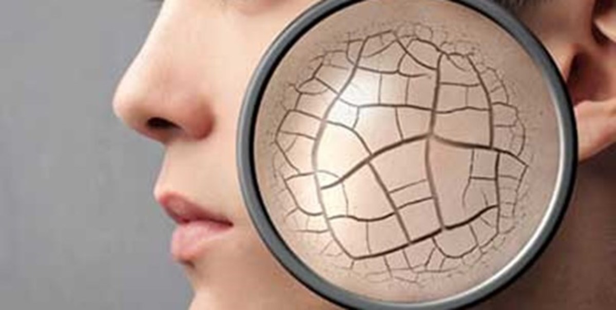 خشکی پوست پاییزی را چگونه درمان کنیم؟