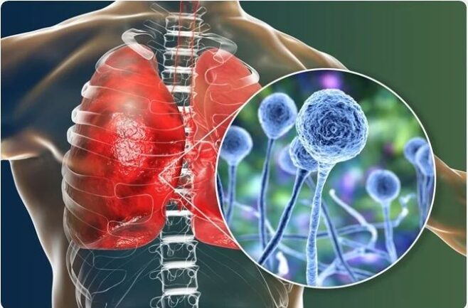 بیماری قارچ سیاه یا موکورومایکوزیس؛ علائم، علت‌ها و درمان