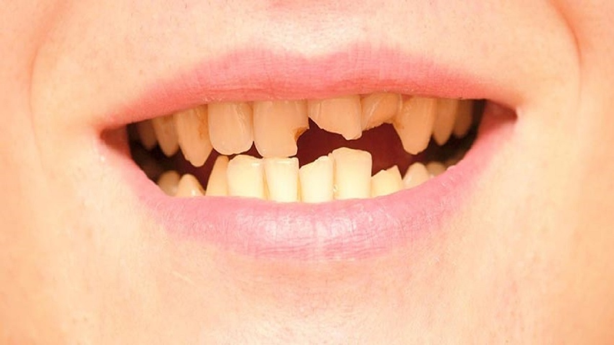 نجات ترک خوردگی و شکستگی دندان با ۸ روش درمانی