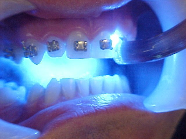 نجات ترک خوردگی و شکستگی دندان با ۸ روش درمانی