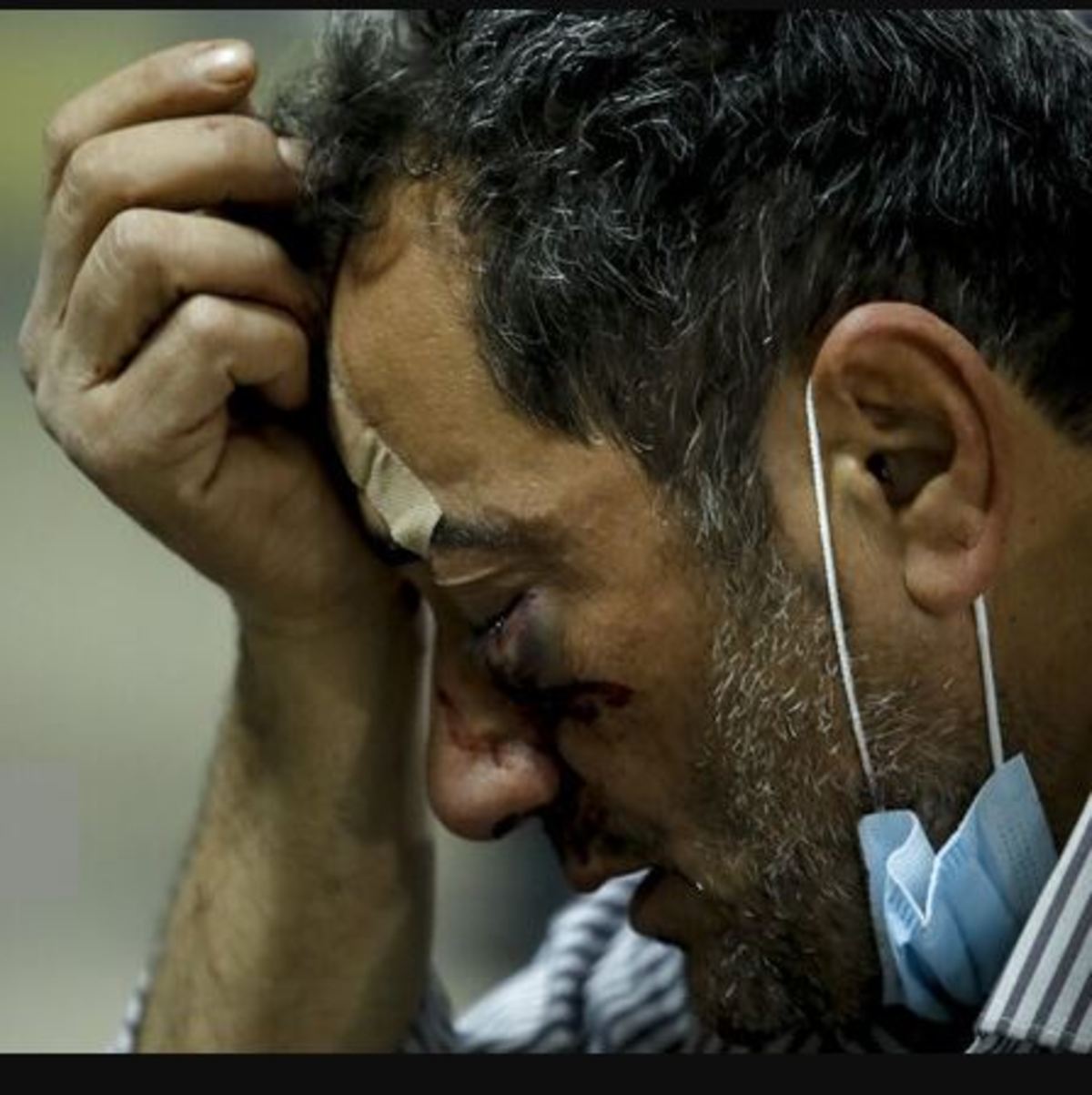 شیوع اختلالات روان‌شناختی پس از تصادفات