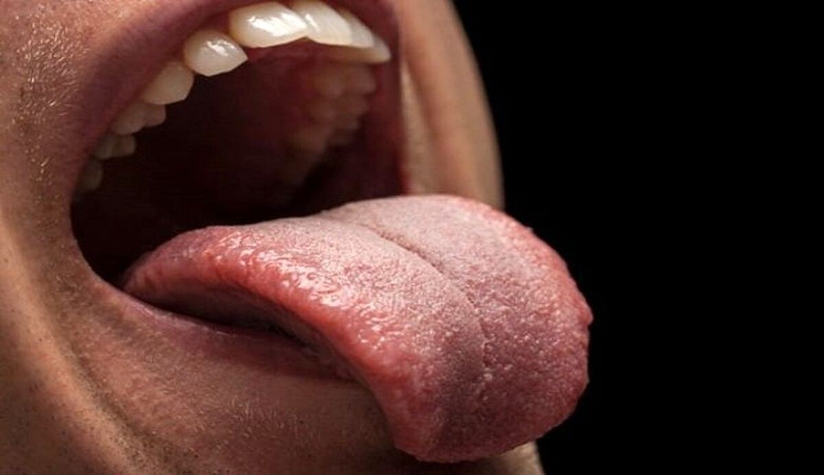 نشانه‌ای در دهان که خبر از وجود سرطان می‌دهد