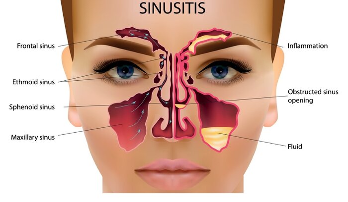 راه تشخیص سینوزیت از سرماخوردگی + راه درمان