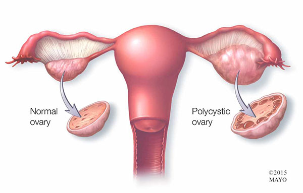 نکات مهم درباره سندرم تنبلی تخمدان در زنان