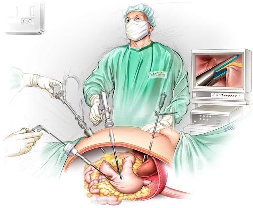 چگونه جراحی لاپاراسکوپی اسلیو گاسترکتومی به کاهش وزن منجر می‌شود؟