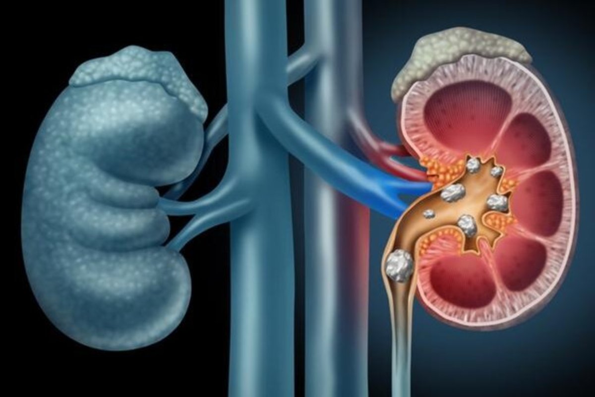 چگونه نارسایی کلیه را تشخیص دهیم؟ ۵ روش کلیدی
