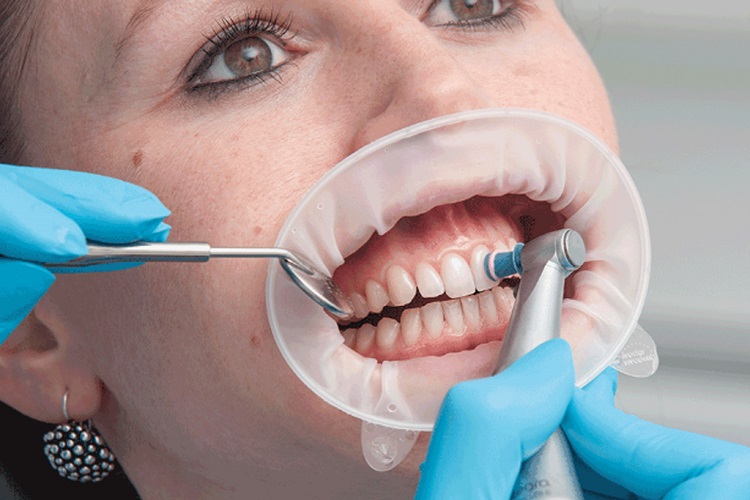 آیا سفید کردن دندان عوارض دارد؟ / انواع روش‌های خانگی و درمانی