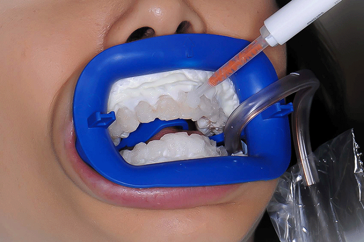 آیا سفید کردن دندان عوارض دارد؟ / انواع روش‌های خانگی و درمانی