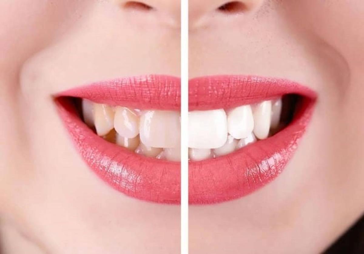لمینت یا کامپوزیت کدام برای داشتن دندان‌هایی زیبا و محکم مناسب است؟