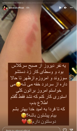 وقتی صبا راد از شدت خستگی دستش را سوزاند