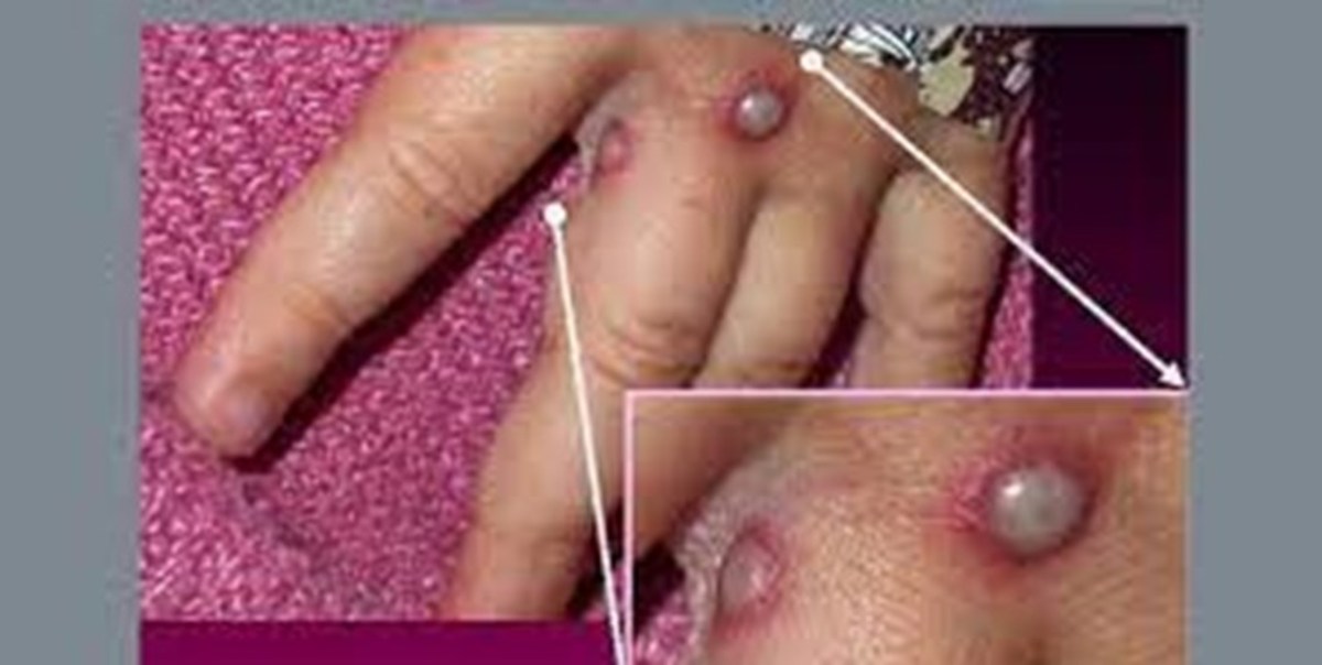 کدام افراد بیشتر در معرض ابتلا به آبله میمون هستند؟