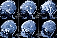 شناسایی زودهنگام سرطان مغز و پروستات با MRI نانویی