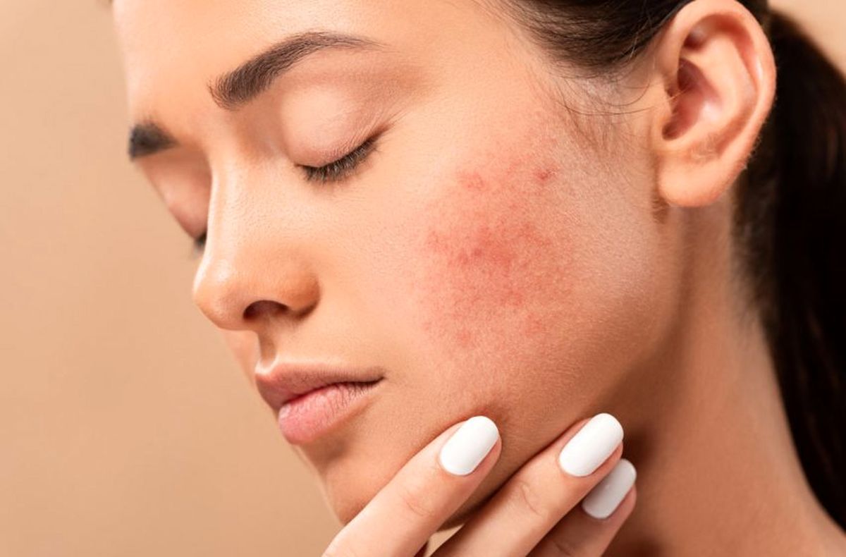 چگونه یک شبه از شر جوش صورت خلاص شویم! ۶ روش سریع