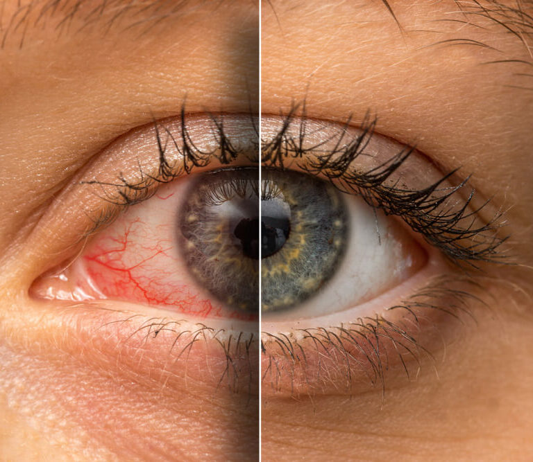 چشم‌ها دریچه‌ای به روح انسان / تشخیص علائم برخی بیماری‌ها از روی چشم