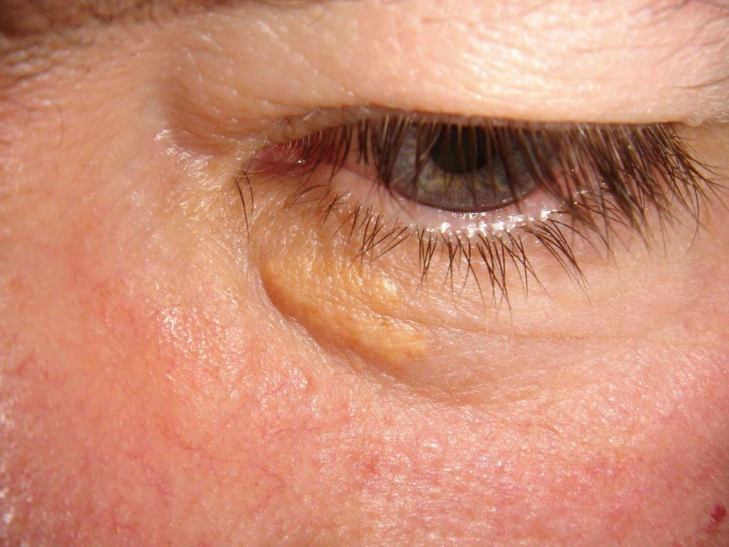 چشم‌ها دریچه‌ای به سلامتی؛ از تشخیص کلسترول تا کم خونی