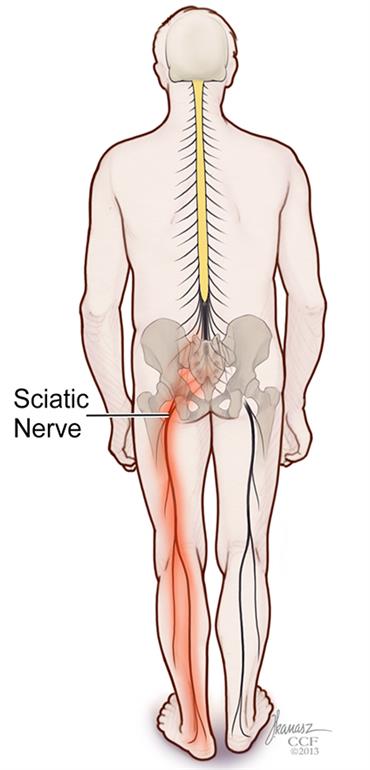 سیاتیک، اسطوره بوکس جهان را به زمین زد/علل و راه درمان سیاتیک چیست؟