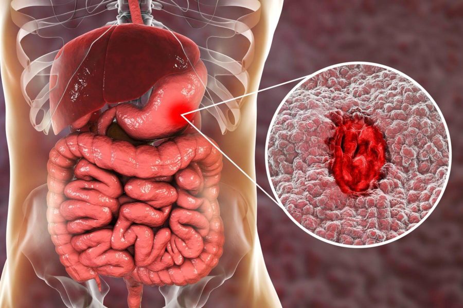 علت ابتلا به زخم معده چیست؟ +راه تشخیص و درمان