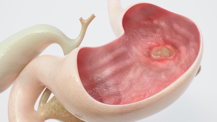 علت ابتلا به زخم معده چیست؟ +راه تشخیص و درمان