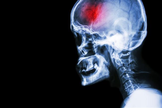 باور‌های رایج، اما غلط در مورد ضربه مغزی + مراقبت‌های لازم