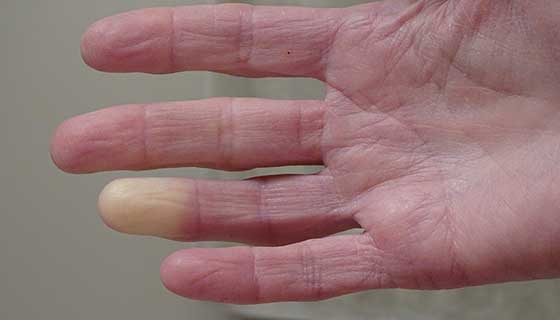 علائم بیماری در دست ها/ از بیماری‌های کبد تا گردش خون ضعیف