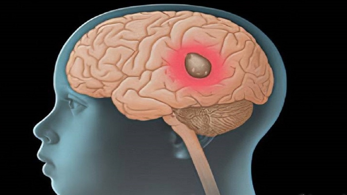 افزایش عمر مبتلایان به سرطان مغز با این واکسن پروفسور ایرانی