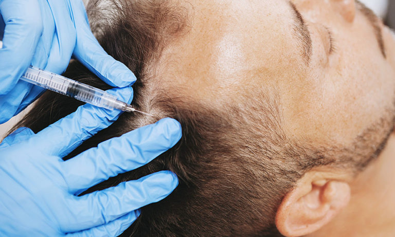 با مزوتراپی از ریزش مو خداحافظی کنید/این روش درمانی روی چه افرادی جواب نمیدهد؟