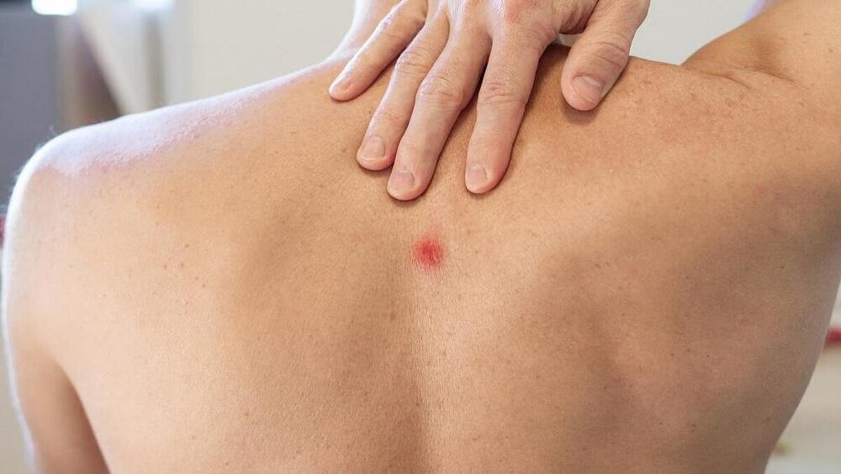 جوش زدن در ناحیه کمر نشانه چیست؟
