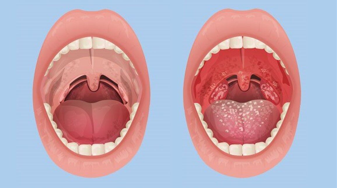 لوزه سوم چیست و چه می‌کند؟