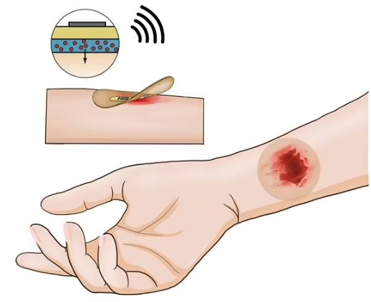 درمان سریع‌تر زخم‌ها با چسب زخم هوشمند