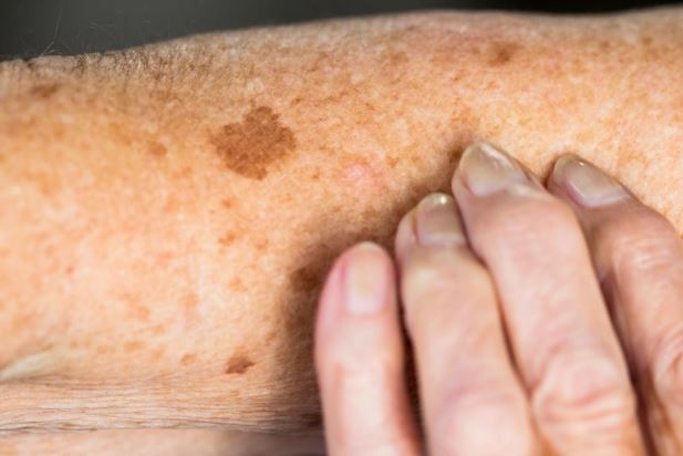 چه لکه‌های پوستی نشانه سرطان هستند؟