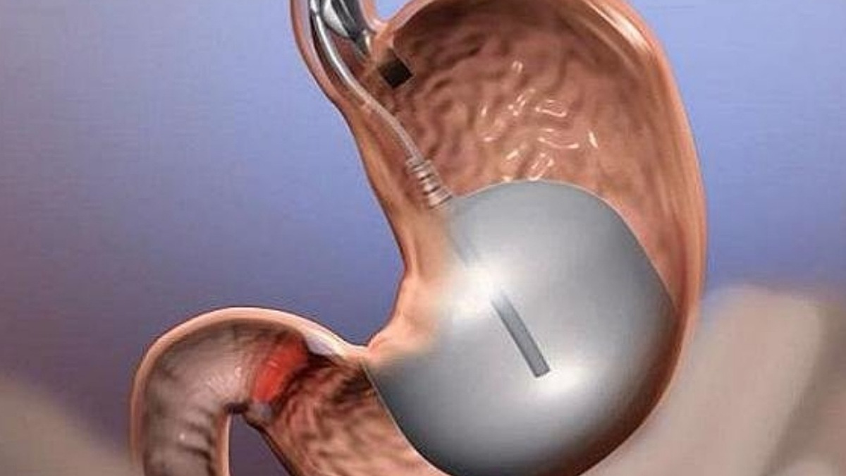 جراحی کاهش وزن عوارض دیابت را کاهش میدهد