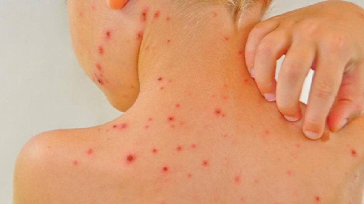 چگونه به ویروس آبله مرغان مبتلا می‌شوید؟