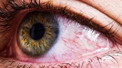 کشف درمانی تاثیرگذار برای سرطان نادر و خطرناک چشم