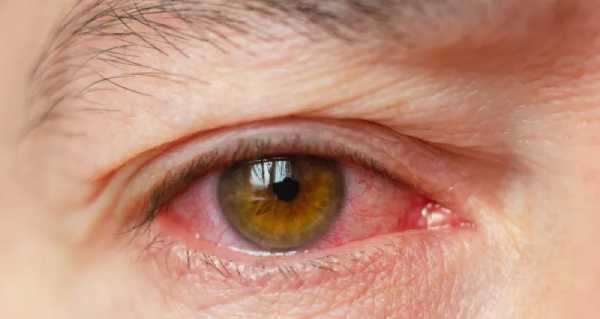 هنگام استفاده از لنز چشم این نکات حیاتی را فراموش نکنید