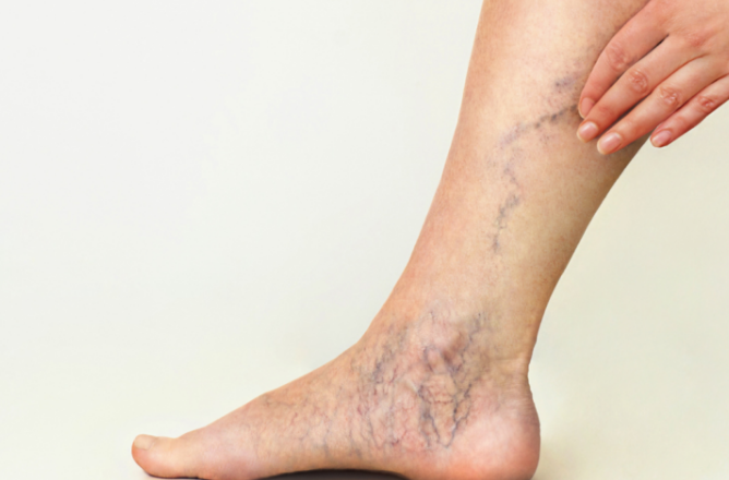 اگر این علائم را در پاهایتان دارید مشکل از کبدتان است