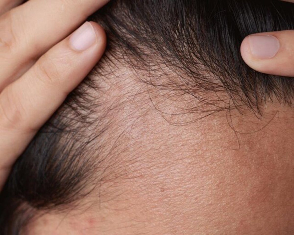چه مقدار ریزش مو در روز طبیعی است؟