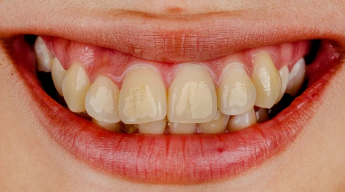 چگونه زردی دندان‌ها را در منزل از بین ببریم؟