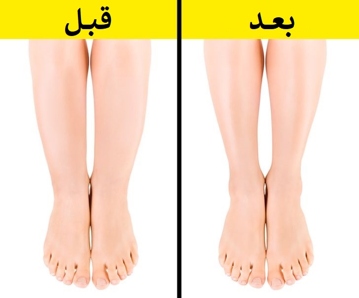 چاقی مچ پا میتواند یک مشکل پزشکی جدی باشد!
