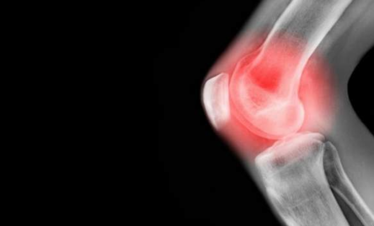 با این اقدامات از آرتروز جلوگیری کنید