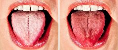 آیا سفید شدن زبان نشانه بیماری است؟