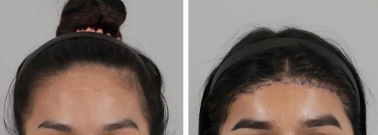 ابعاد مختلف جراحی کوتاه کردن پیشانی و عوارض آن