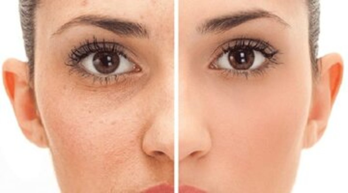 لیزر‌های جوانساز چقدر برای لک‌های صورت مفیدند؟