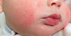 درمان‌ها خانگی برای رفع قرمزی پوست صورت نوزاد و راش پوستی