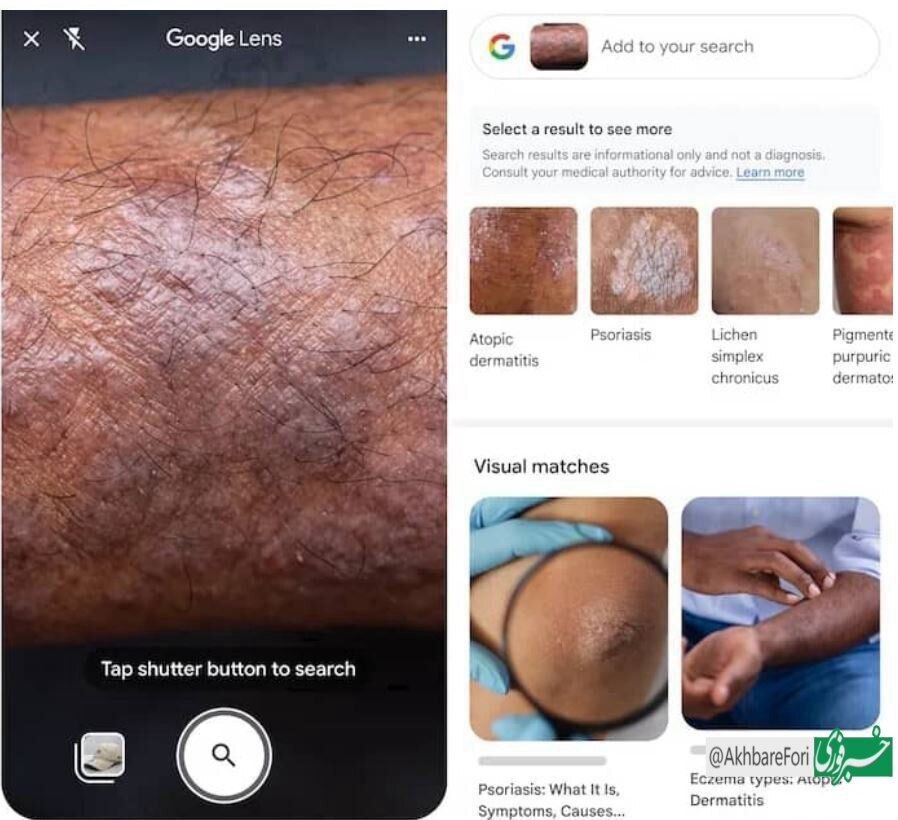 وقتی گوگل لنز تخصص بیماری‌های پوستی می‌گیرد!